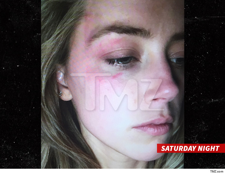 0527-amber-heard-injury-tmz-3.jpg